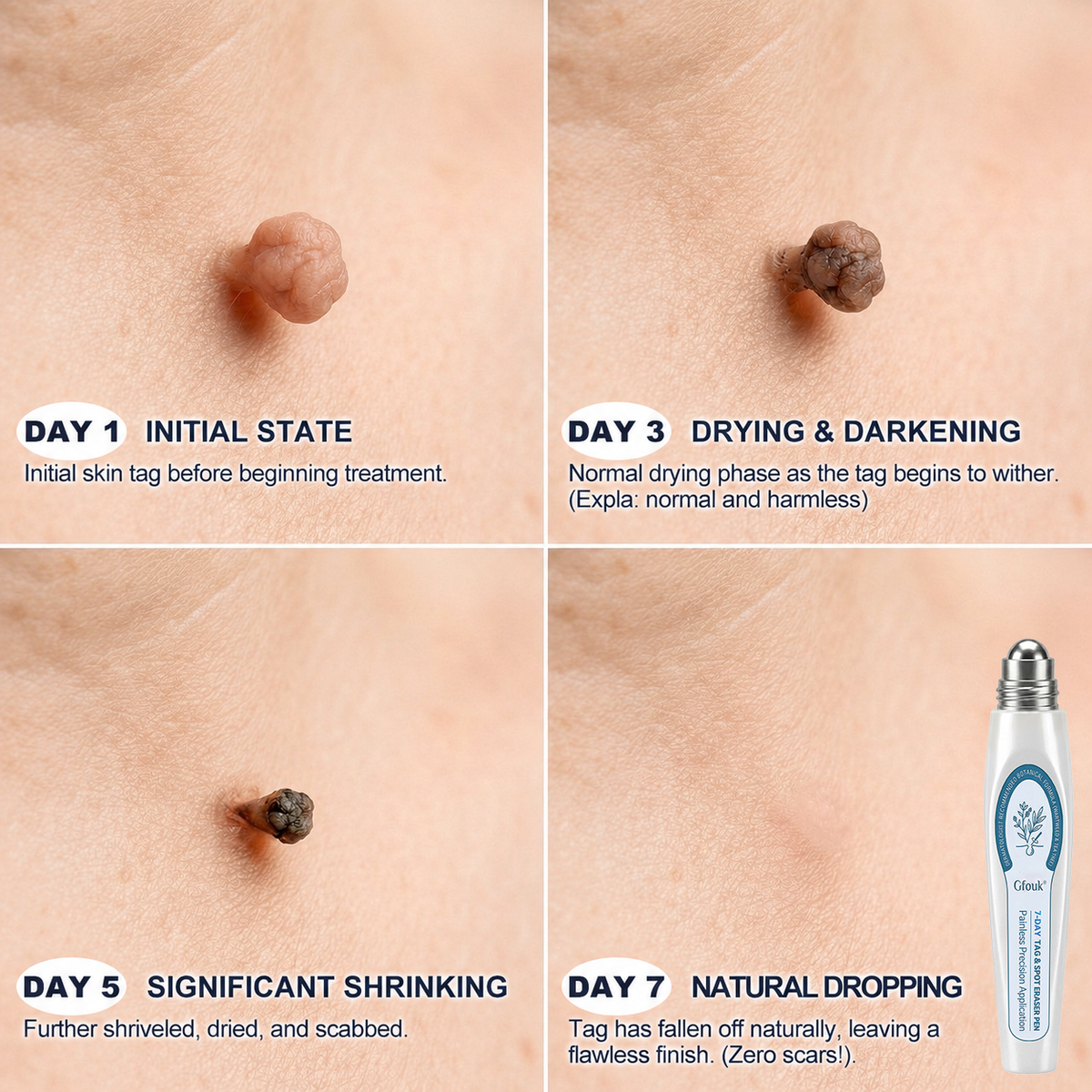 𝐎𝐟𝐟𝐢𝐜𝐢𝐚𝐥 𝐁𝐫𝐚𝐧𝐝 𝐒𝐭𝐨𝐫𝐞 |✒️GFOUK® Fast-Acting Wart Remover Care Pen | Targets Warts, Skin Tags & Rough Bumps(Zero Pain, Zero 𝐒𝐜𝐚𝒓𝒔 Rollerball)