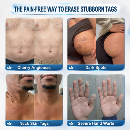 𝐎𝐟𝐟𝐢𝐜𝐢𝐚𝐥 𝐁𝐫𝐚𝐧𝐝 𝐒𝐭𝐨𝐫𝐞 |✒️GFOUK® Fast-Acting Wart Remover Care Pen | Targets Warts, Skin Tags & Rough Bumps(Zero Pain, Zero 𝐒𝐜𝐚𝒓𝒔 Rollerball)