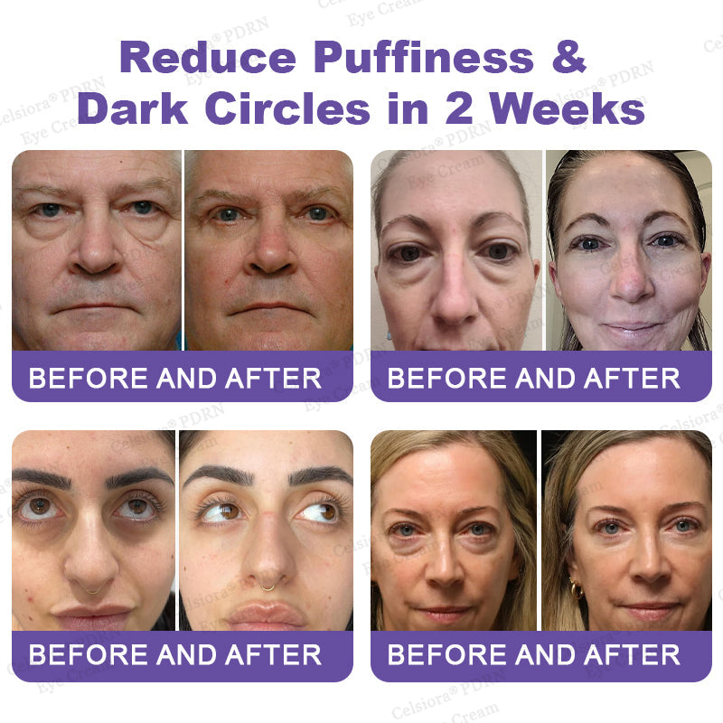 🏅✨Celsiora® PDRN Renewal Complex Eye Cream | Wrinkles, Puffiness & Dark Circles