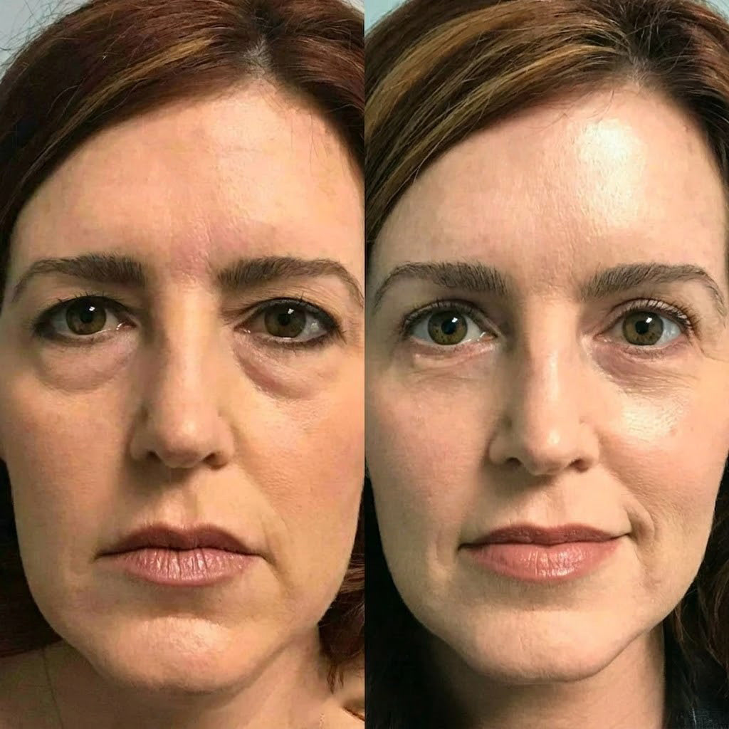 Rolimey® Wrinkle-Lift Tightening cream
